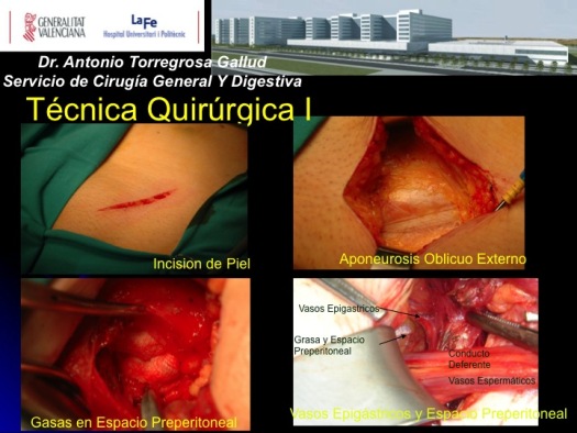 Técnica quirúrgica Hernioplastia Preperitoneal anterior vía clásica a lo Pellisier