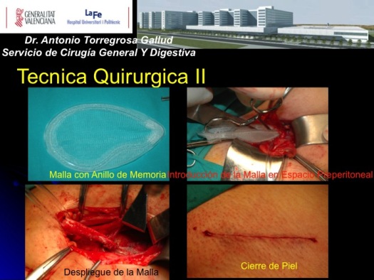 Hernioplastia Preperitoneal por vía clásica anterior a lo Pellisier II