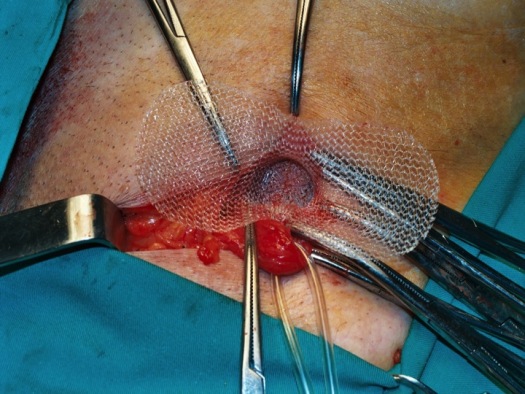 Malla posicionada y expandida su hoja posterior en el espacio preperitoneal