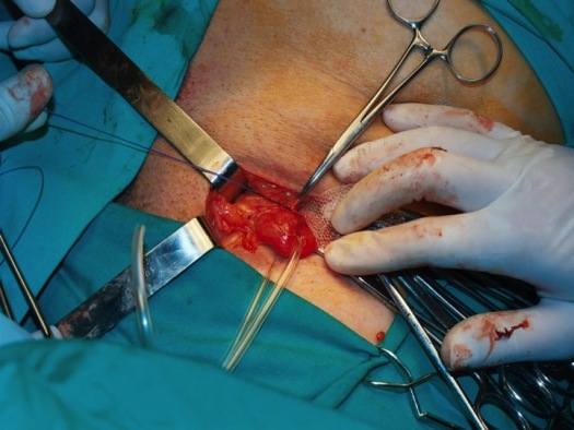 Fijación de la hoja posterior a la fascia transversalis