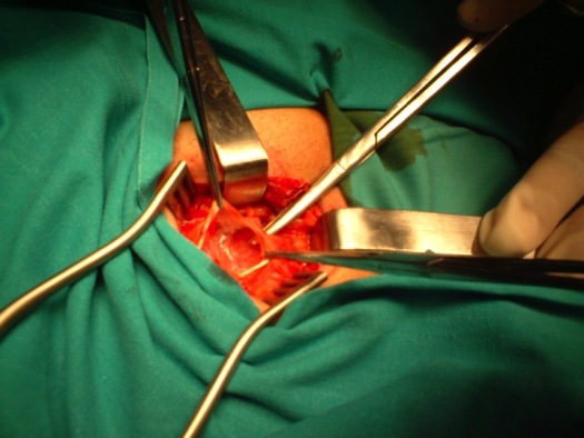 Apertura de la aponeurosis del oblicuo mayor