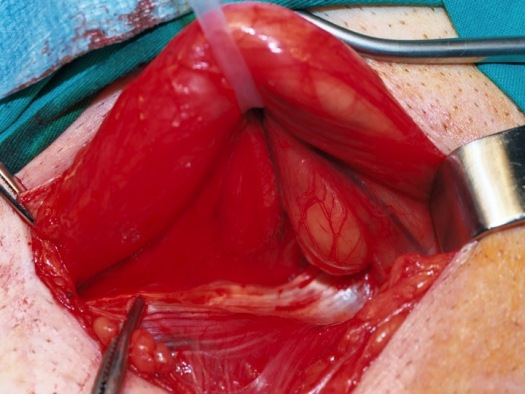 Liberación del cordón