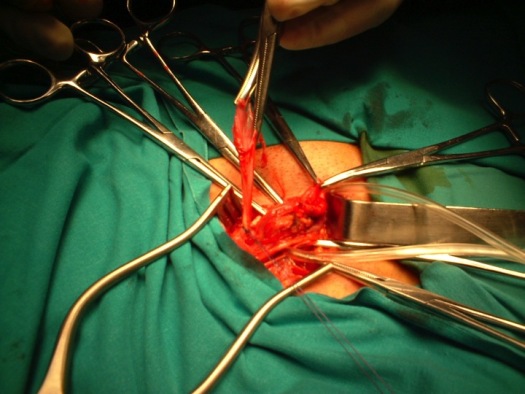 Ligadura alta del saco herniario