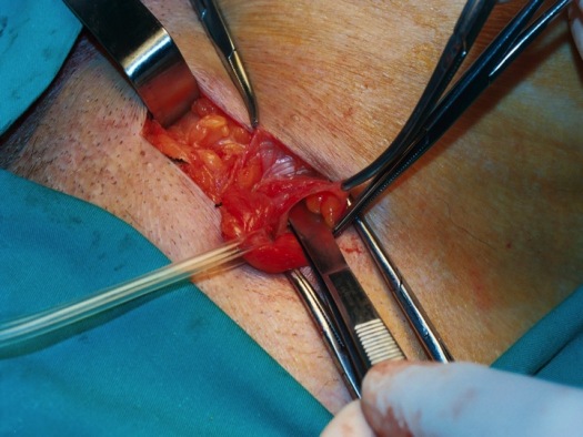 Apertura de la fascia transversalis y liberación del espacio preperitoneal