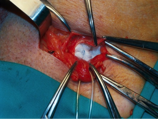 Realización y ampliación del espacio preperitoneal con gasa o compresa para una adecuada expansión de la malla inferior