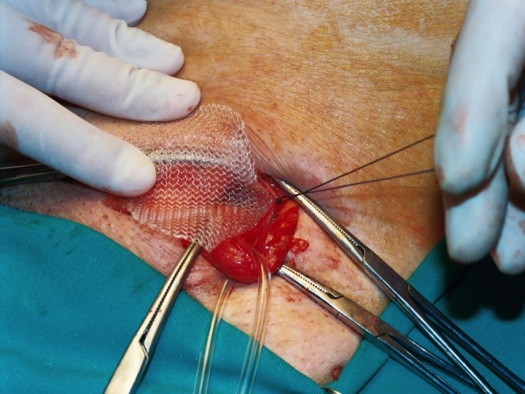 Fijación de la hoja posterior de la malla a la fascia transversalis (2)