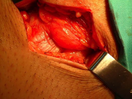 Apertura Piel, Tejido Celular Subcutáneo y Visión Aponeurosis Oblicuo Mayor