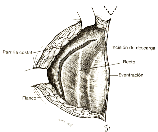 Incisión descarga Zavaleta
