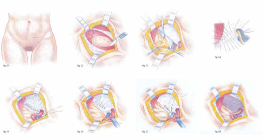 Técnica de Nyhus paso a paso