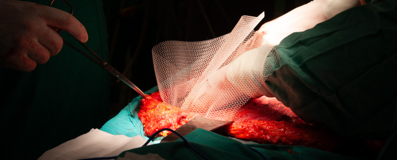 imagen malla en cirugía abierta